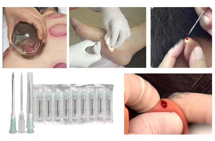 TCM cupping and bloodletting therapies TCM cupping and bloodletting therapies